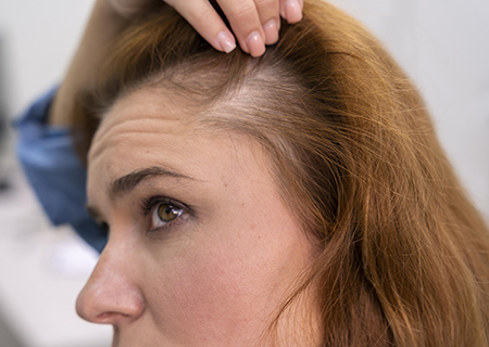 woman getting hair loss treatment